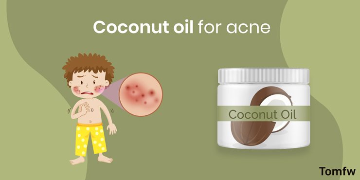 coconut oil for acne
