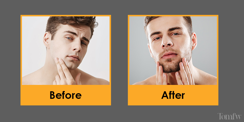 beard transplant before and after