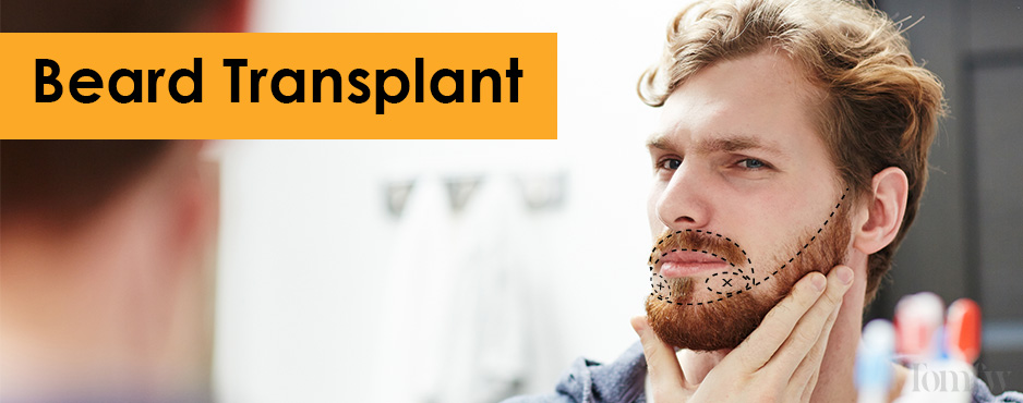 beard transplant