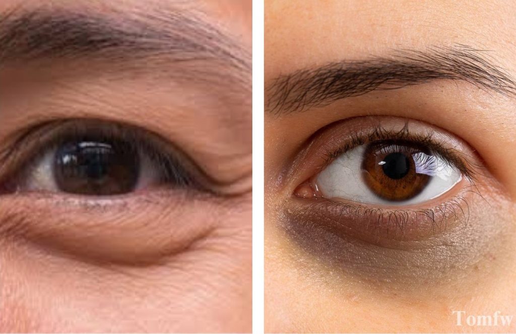 eye bags vs dark circles
